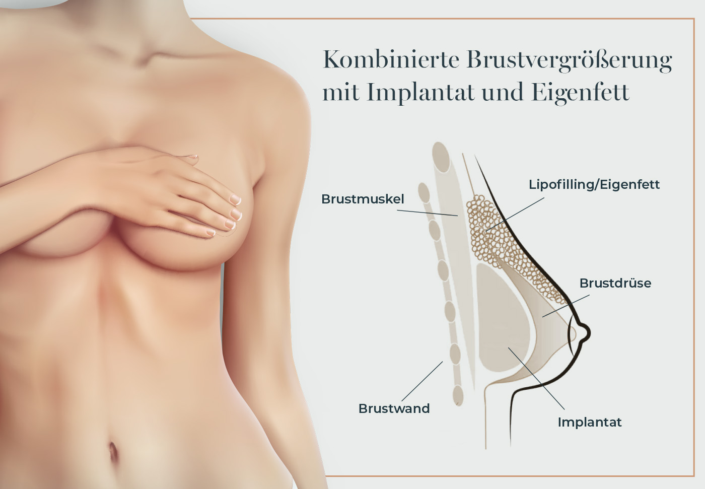 Grafik zur Hybrid Brustvergrößerung