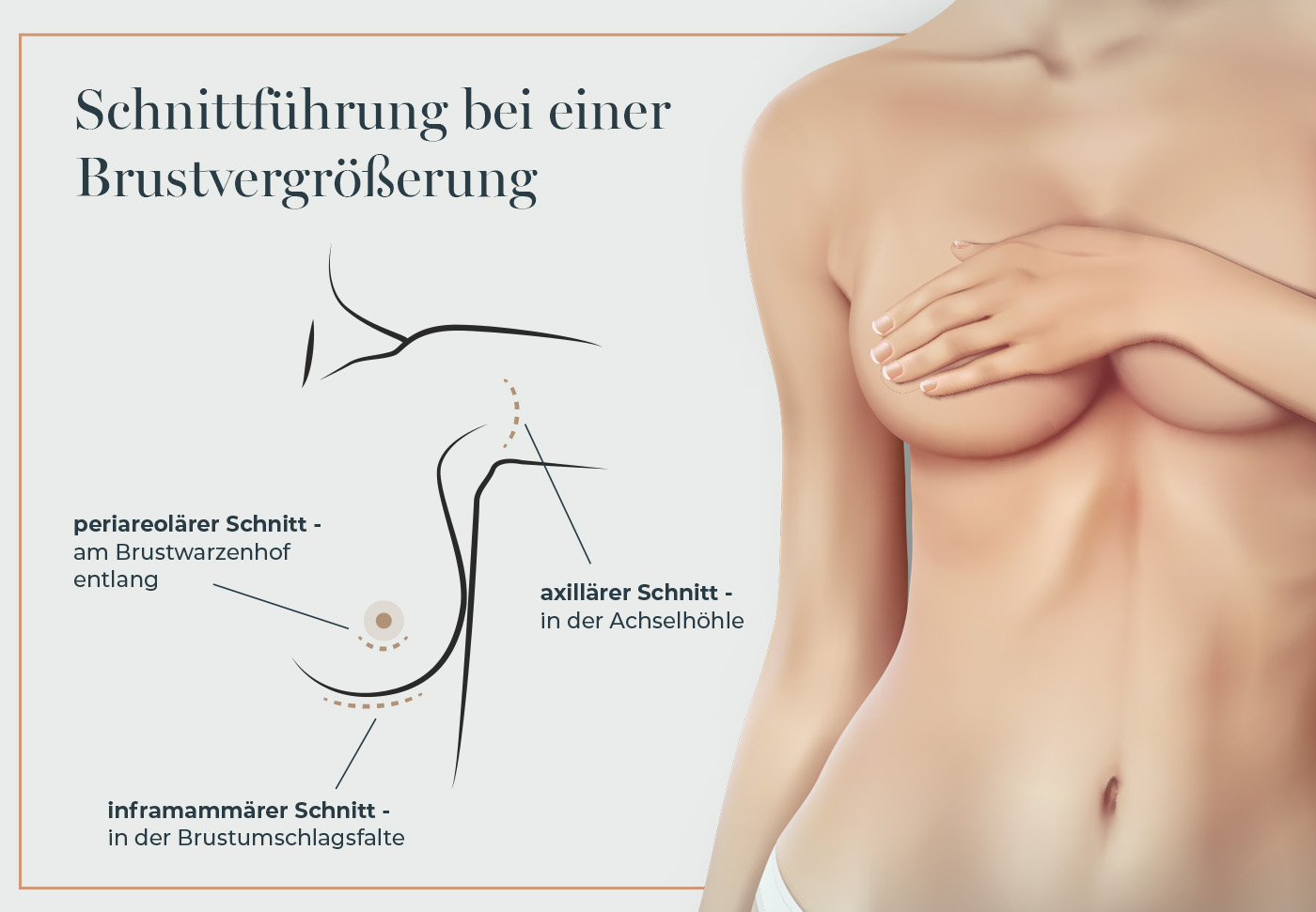 OP-Methode: Schnittführung bei einer Brustvergrößerung mit Implantat