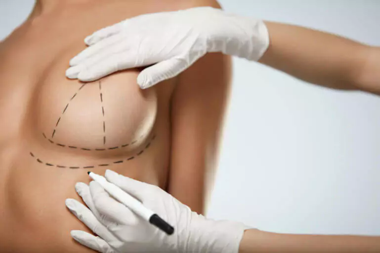 Müssen Brustimplantate mit der Zeit ausgetauscht werden? – 4 Gründe für einen Implantatwechsel