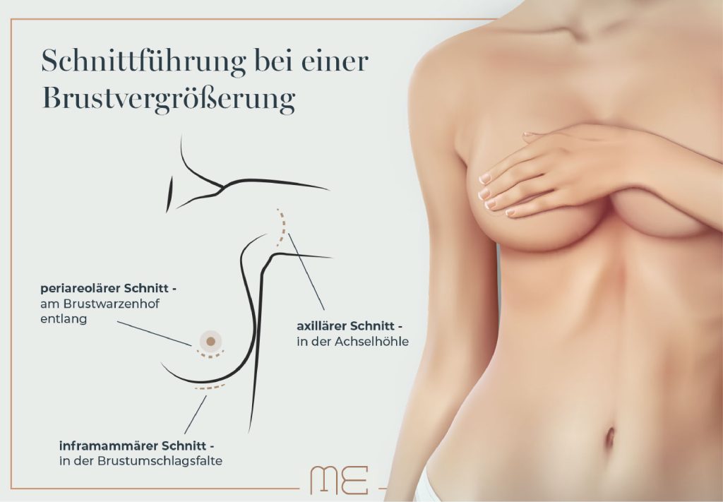 Brustvergrößerung Methoden der Schnittführung