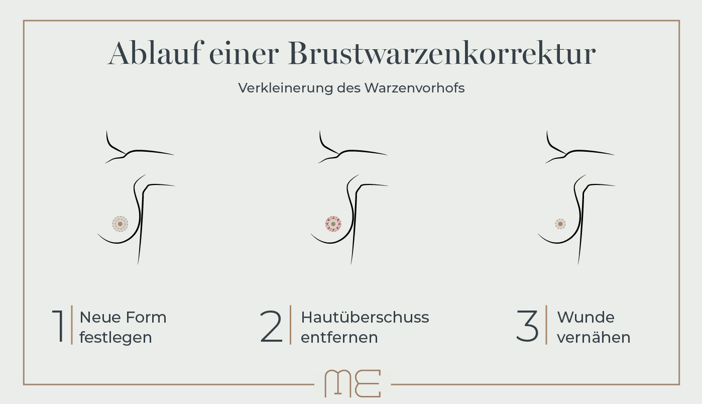 Grafik zum Ablauf einer Brustwarzenkorrektur