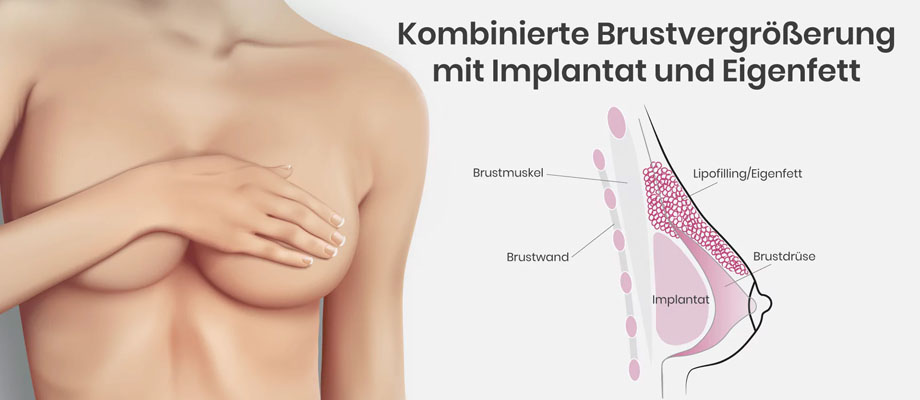 Hybrid Brustvergrößerung (Composite Breast Augmentation) ist eine kombinierte Brustvergrößerung aus Eigenfett (Lipofilling) & Implantaten