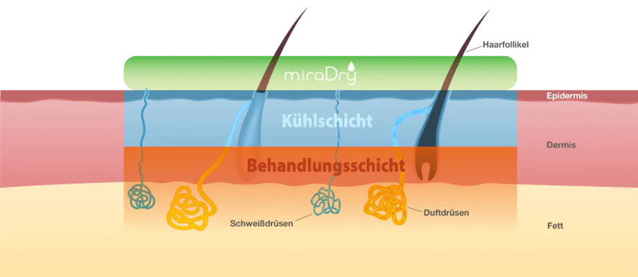 Grafik zur miraDry® Behandlung