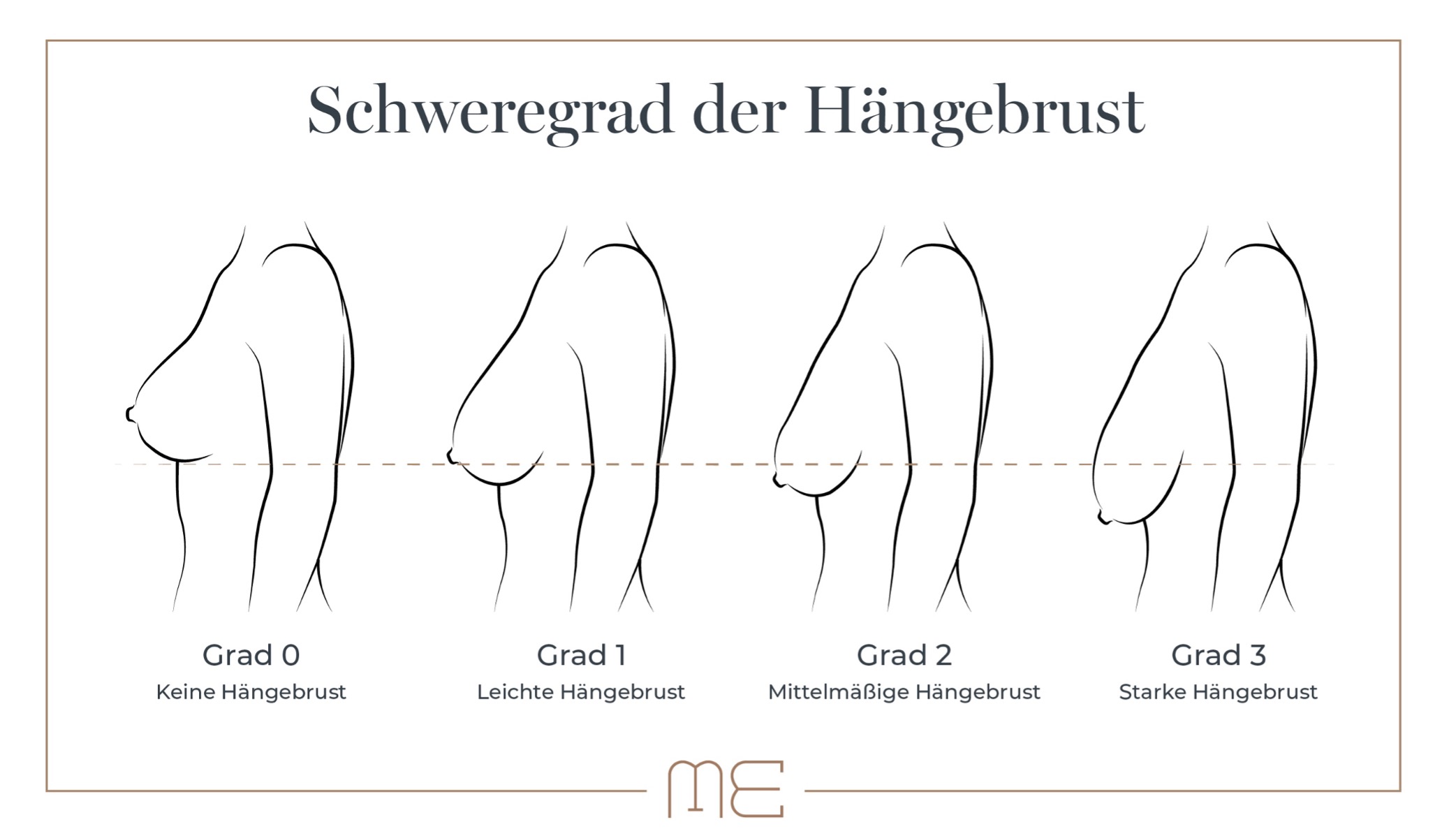 schweregrade-haengebrust-eder