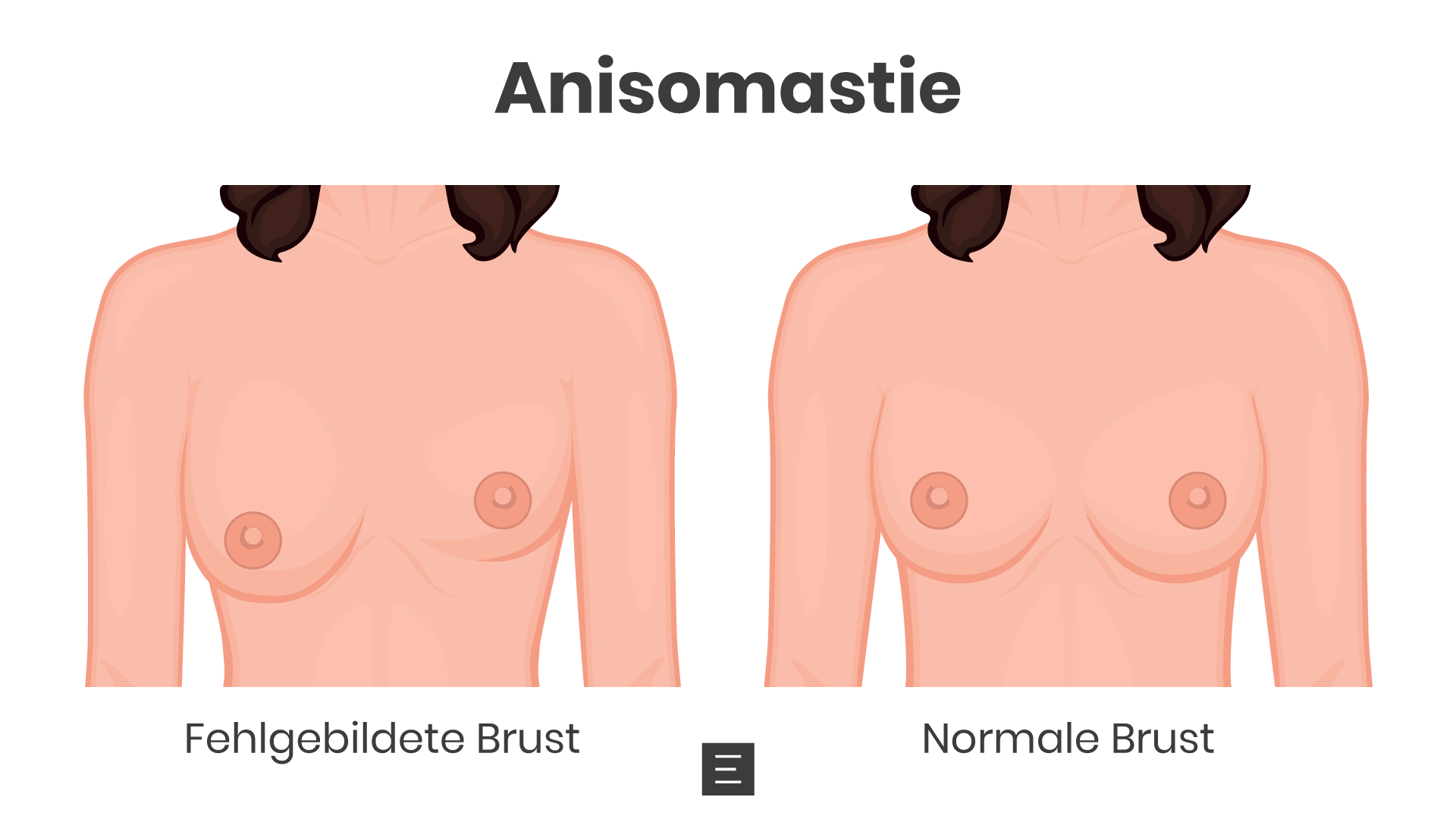 brustasymmetrie-anisomastie-pd-dr-med-maximilian-eder