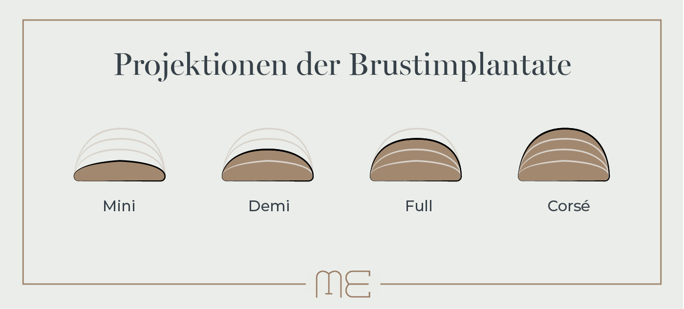 Grafik zu Größen der Brustimplantate