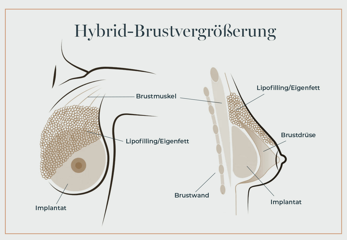 Grafik zur Hybrid Brustvergrößerung