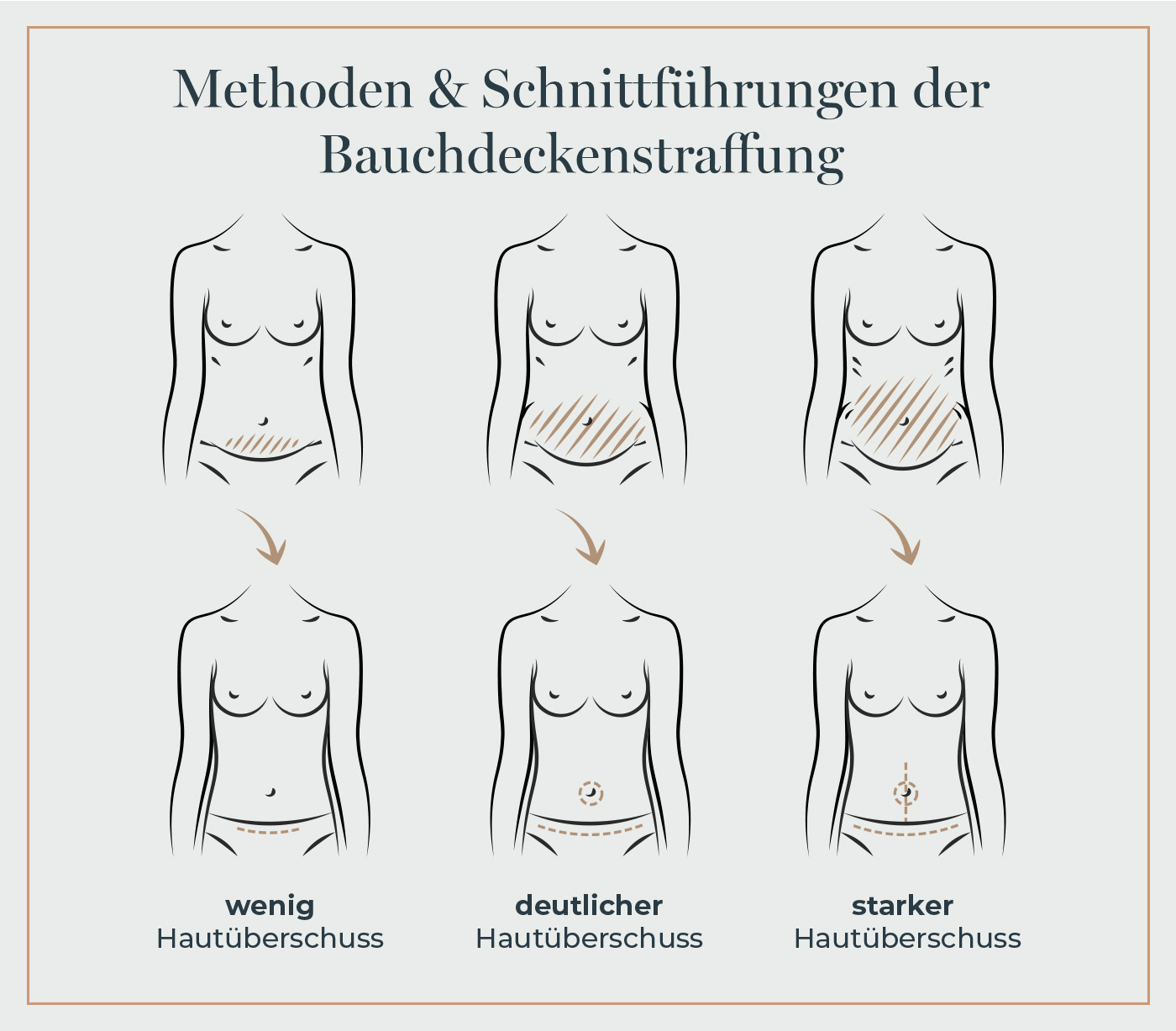 Grafik zur Bauchdeckenstraffung