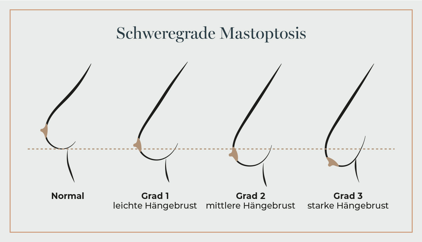 Grafik zur Bruststraffung