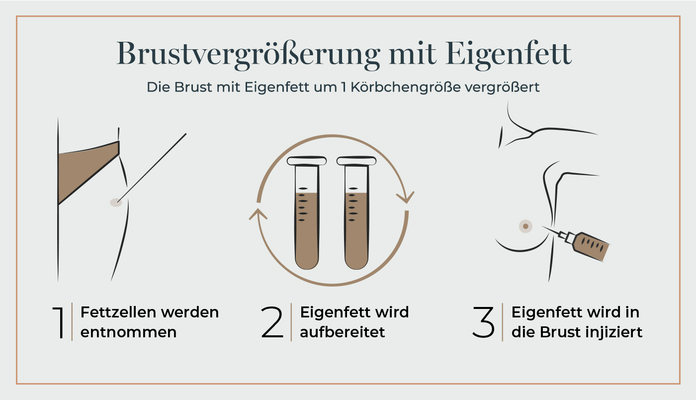 Grafik zur Brustvergrößerung mit Eigenfett