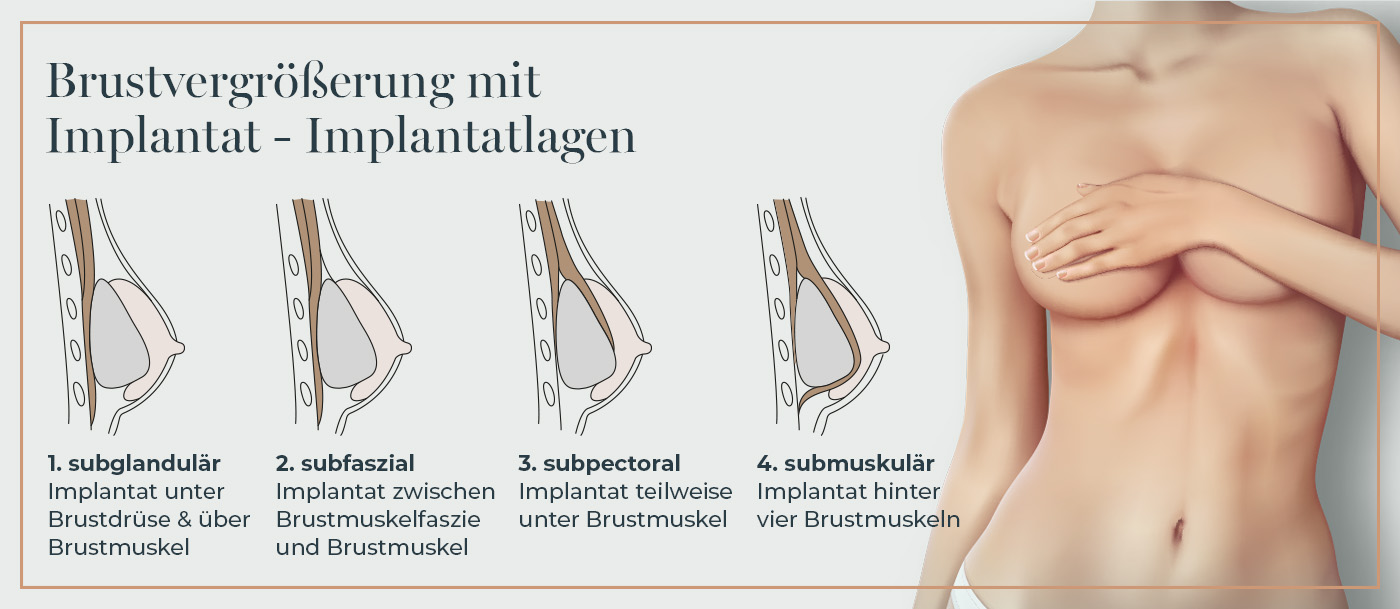 Möglichkeiten zur Brustvergrößerung mit Implantat