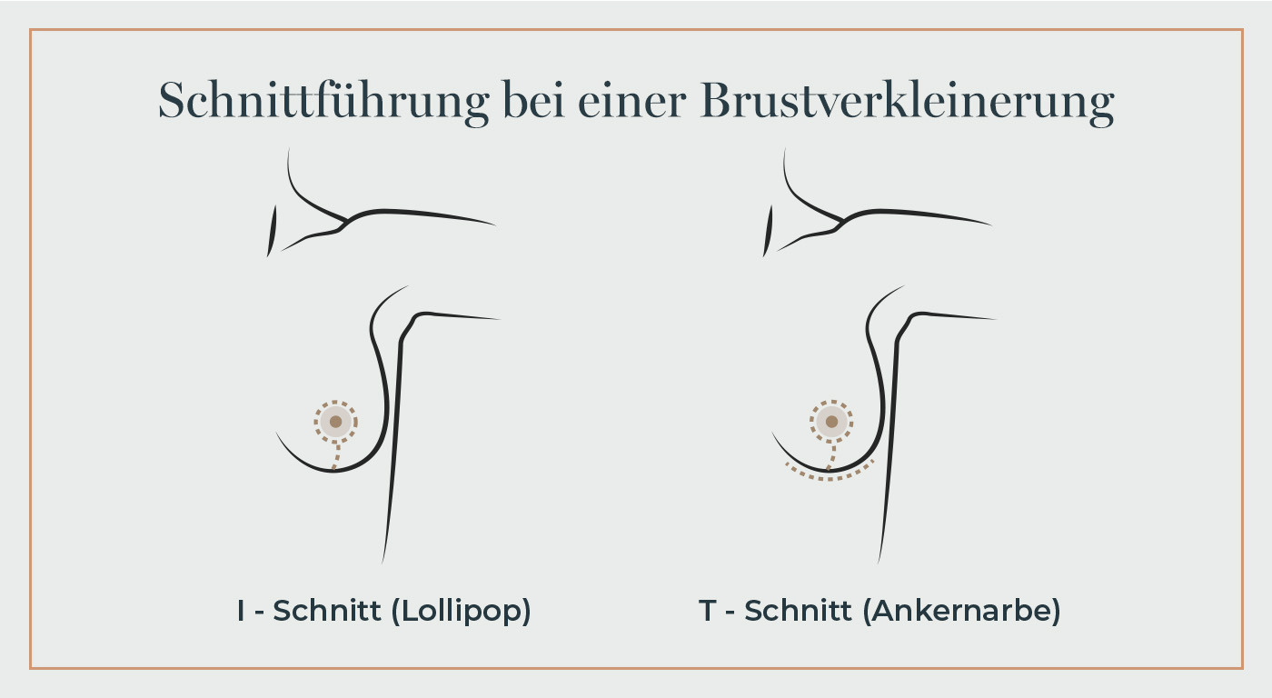 Grafik zur Brustverkleinerung