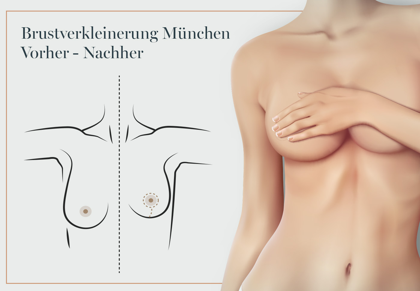 Grafik zur Brustverkleinerung