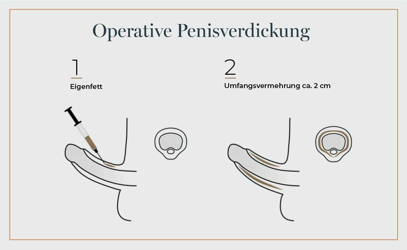 Grafik zur Penisverdickung