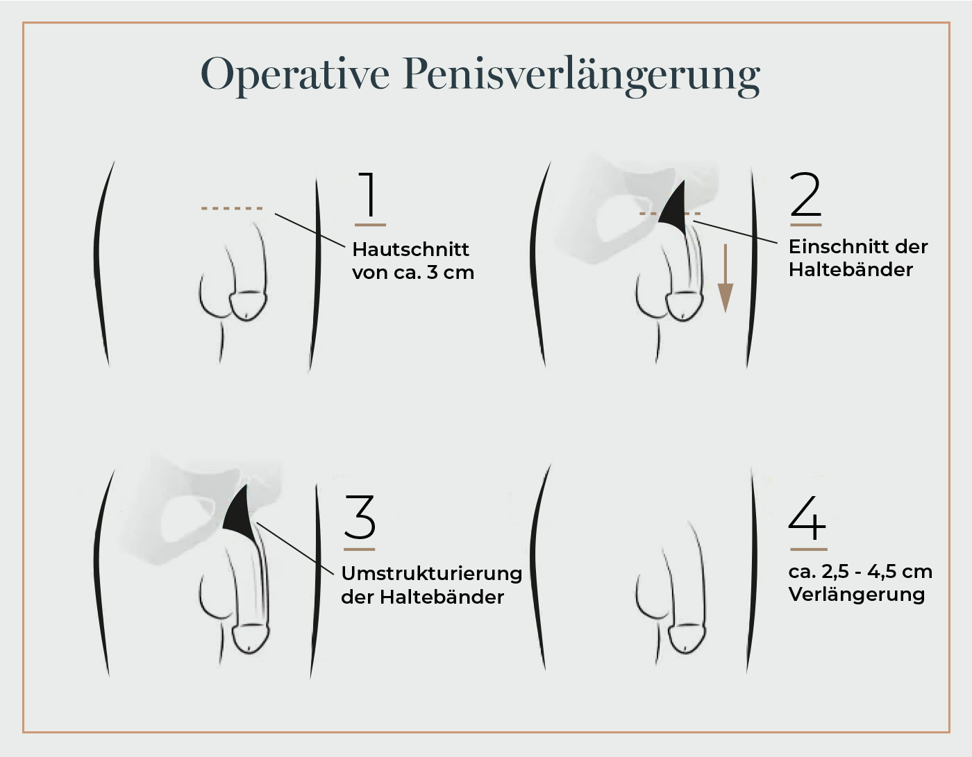 Penisverlängerung Dr. Eder