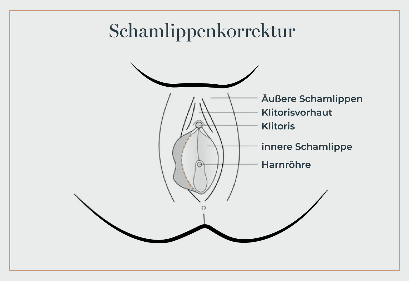 Grafik zur Schamlippenverkleinerung