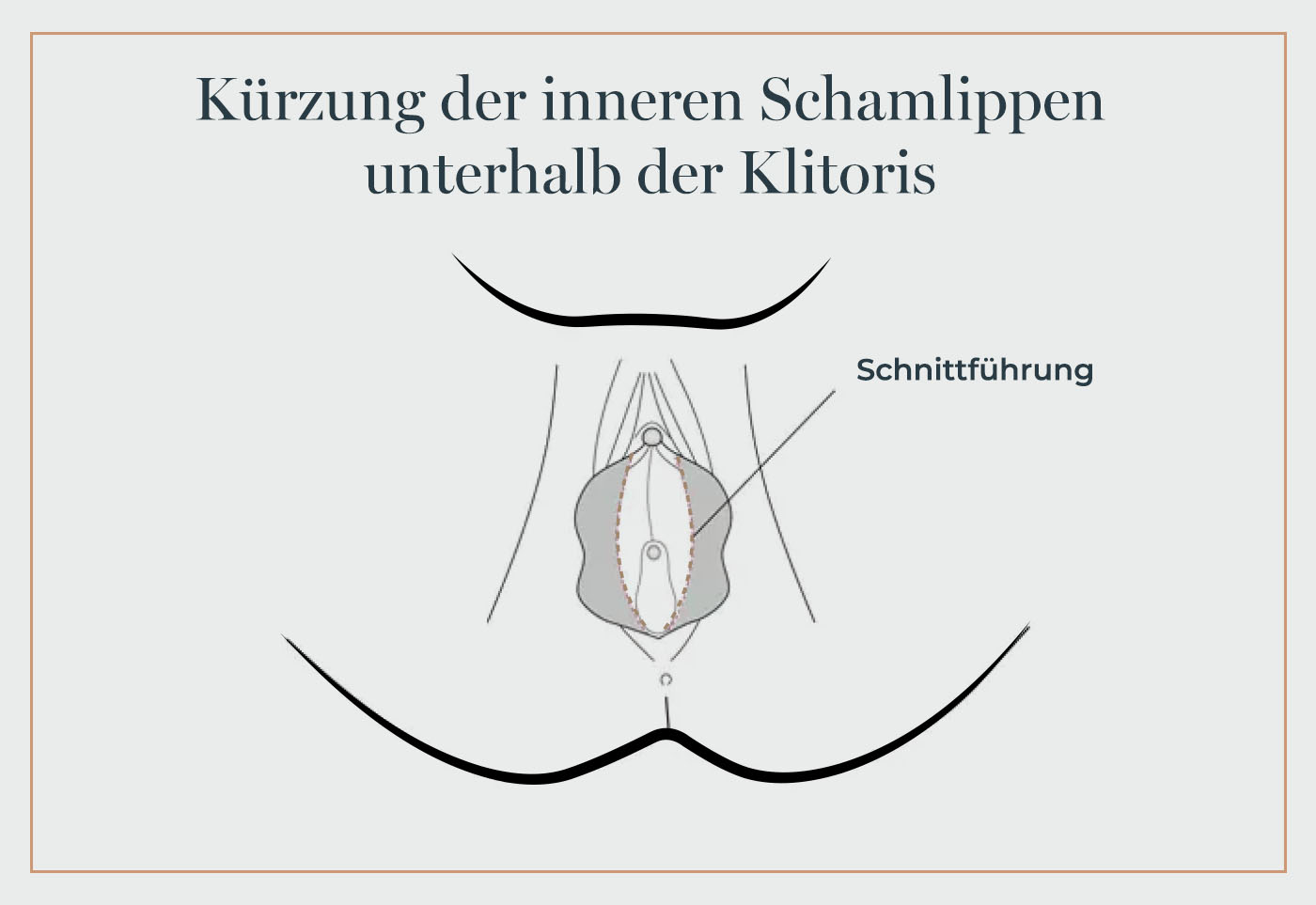 Grafik zur Schamlippenverkleinerung