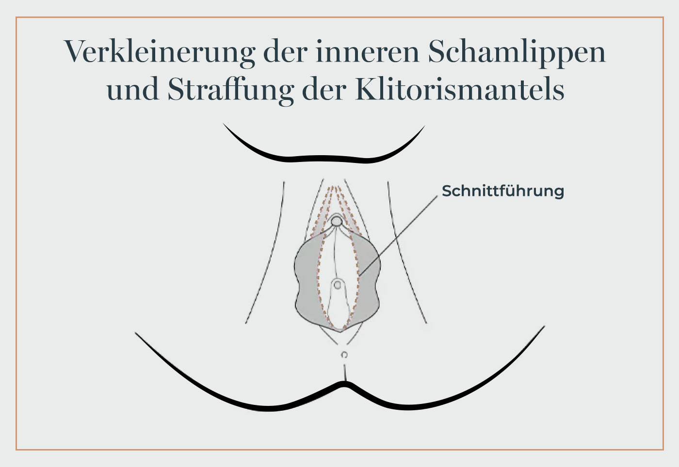 Schamlippenkorrektur und Straffung Klitorismantel