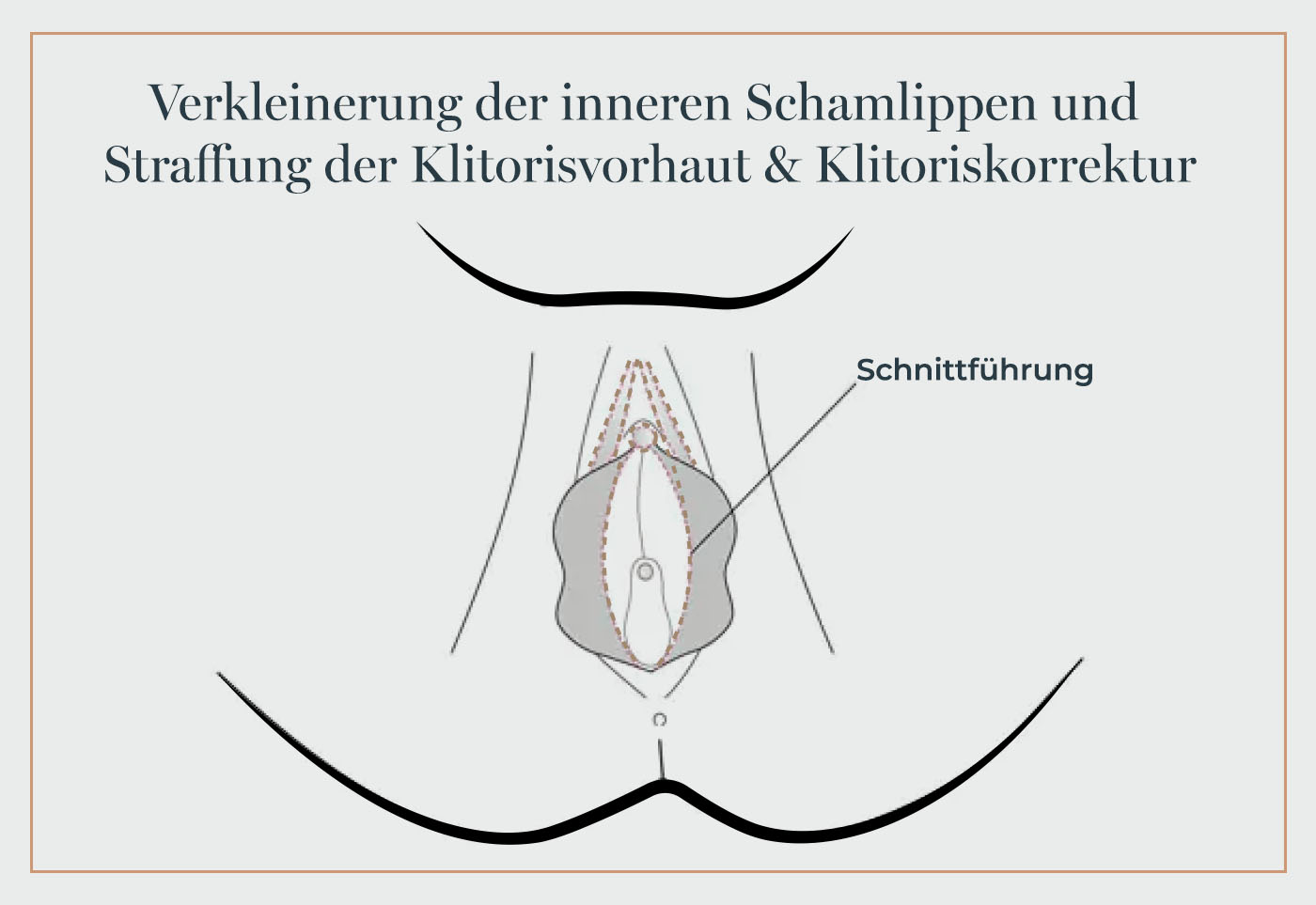 Grafik zur Schamlippenkorrektur