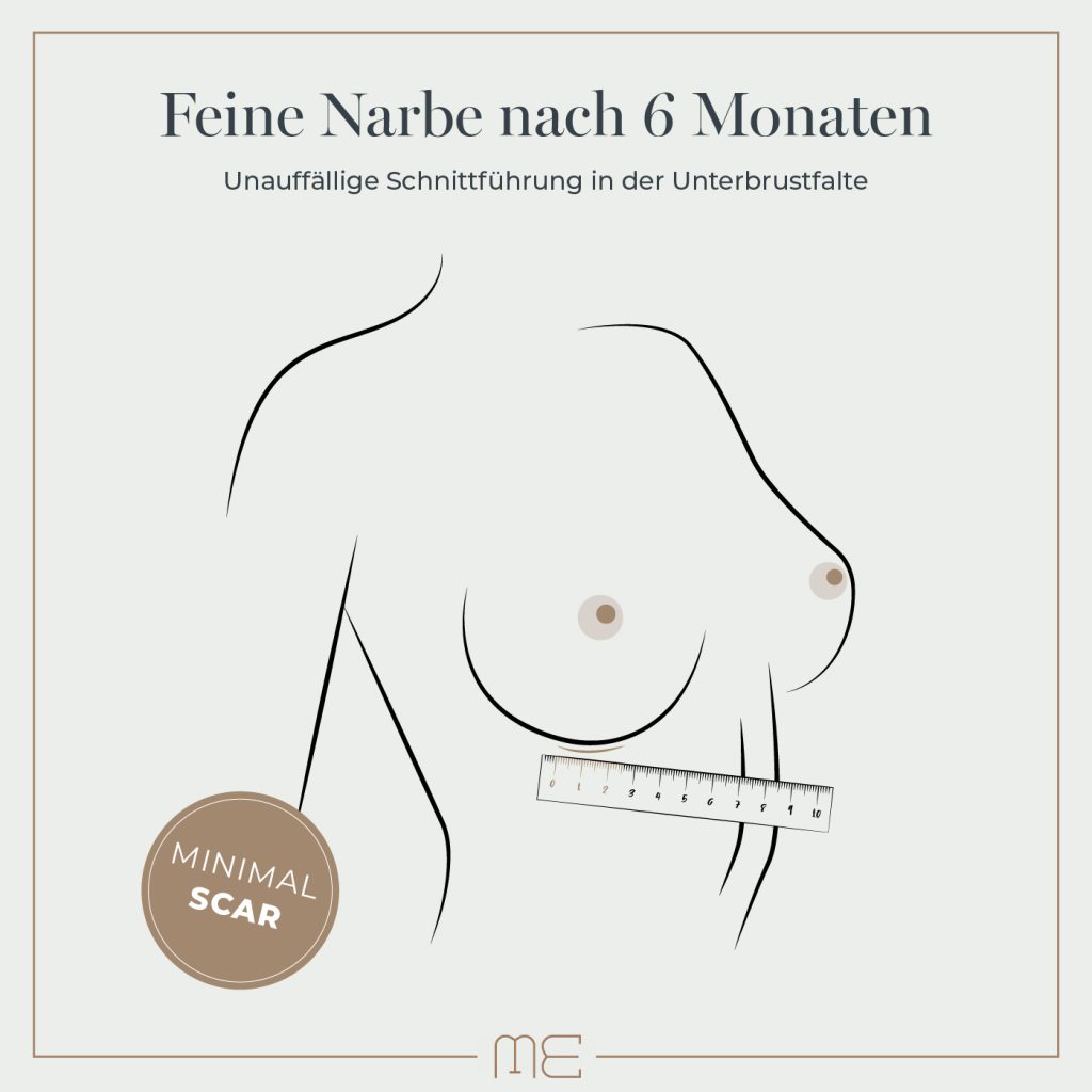 Brustvergrößerung Narbe nach 6 Monaten (Minimal Scar)