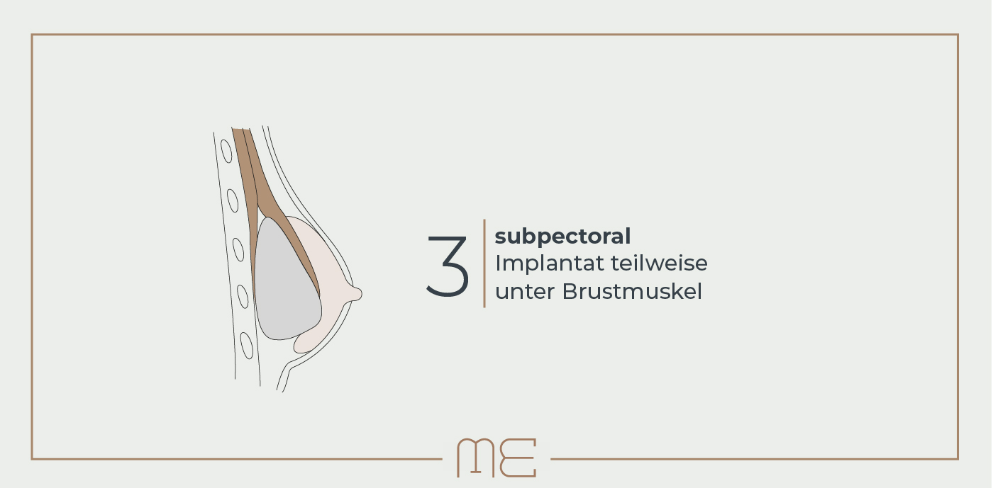 Brustvergrößerung: Implantatlage teilweise unter dem Brustmuskel