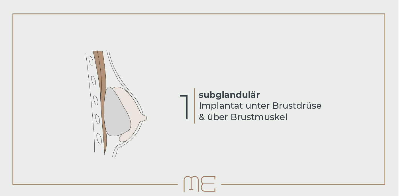 Brustvergrößerung: Implantatlage über dem Brustmuskel