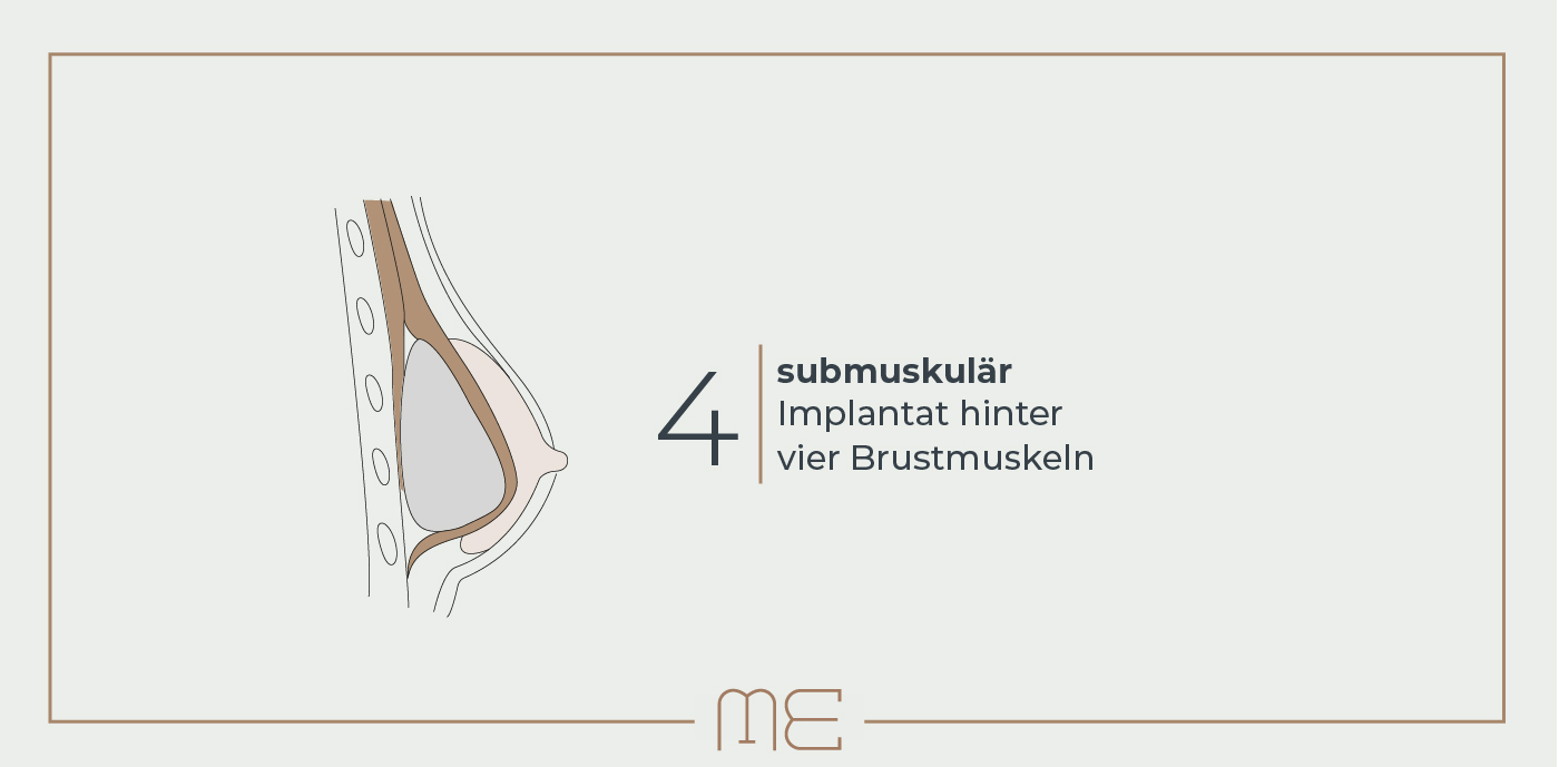 Brustvergrößerung: Implantatlage unter dem Brustmuskel