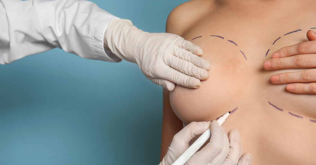 Bruststraffung mit Implantat in München – natürliche Ergebnisse und transparente Kosten