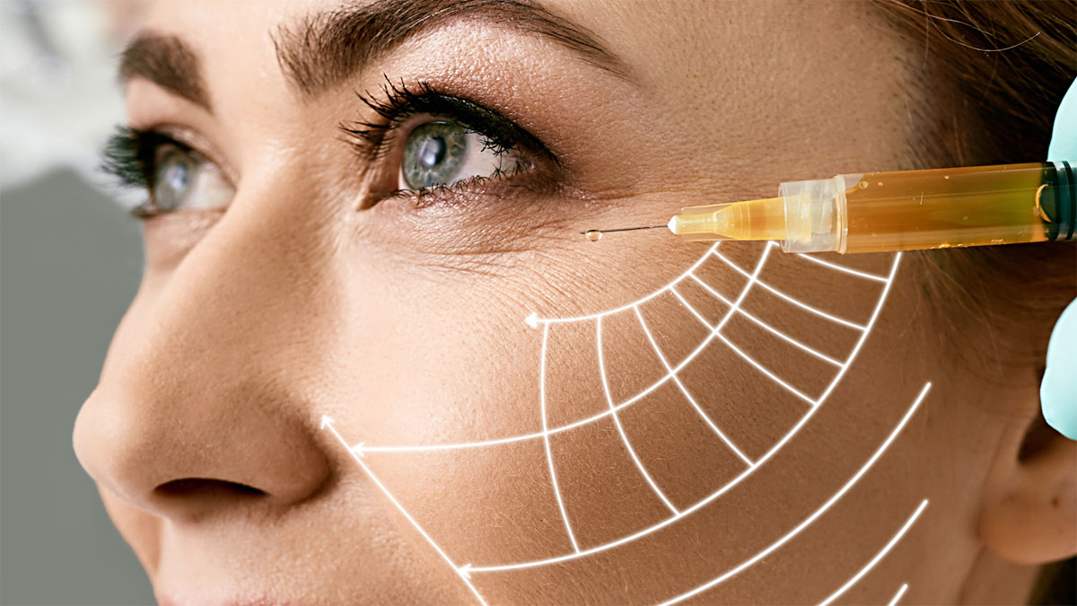 Lipofilling mit eigenfett im Gesicht